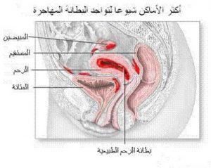 بطانة الرحم المهاجرة