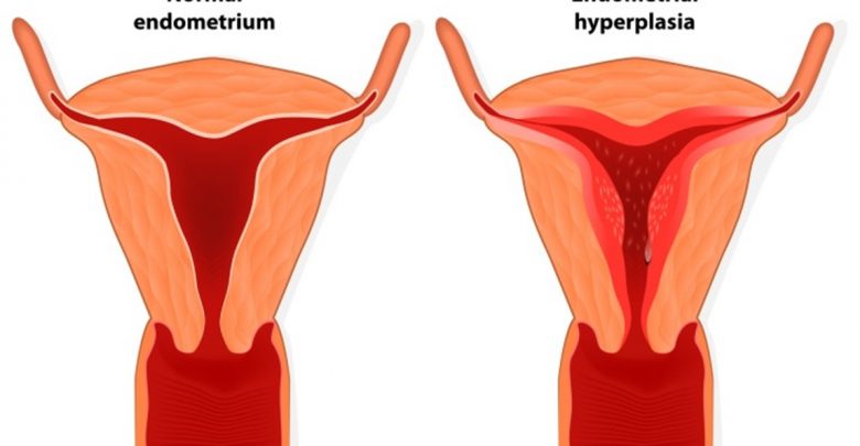 بطانة الرحم المهاجرة