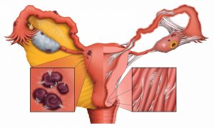 بطانة الرحم المهاجرة
