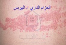 الحزام الناري