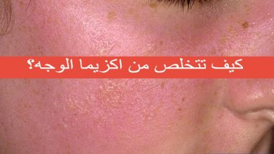 اكزيما الوجه