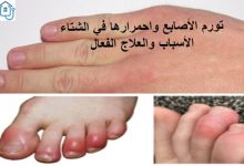 تورم الاصابع في الشتاء