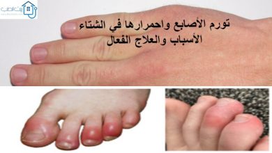 تورم الاصابع في الشتاء